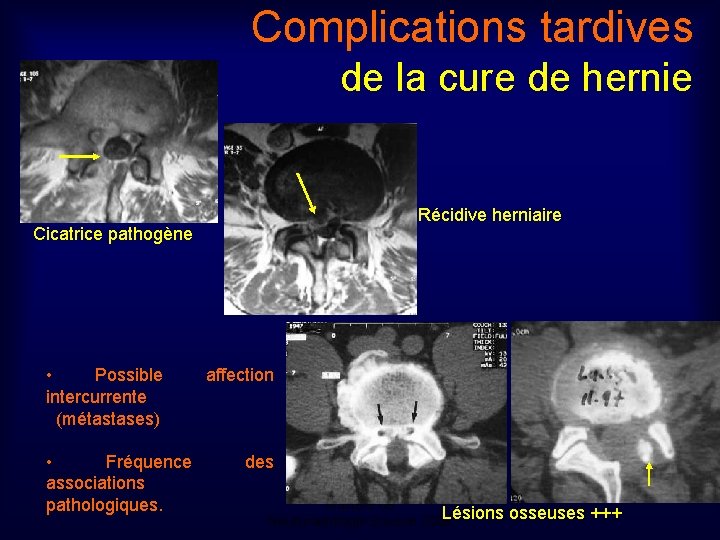 Complications tardives de la cure de hernie Récidive herniaire Cicatrice pathogène • Possible intercurrente