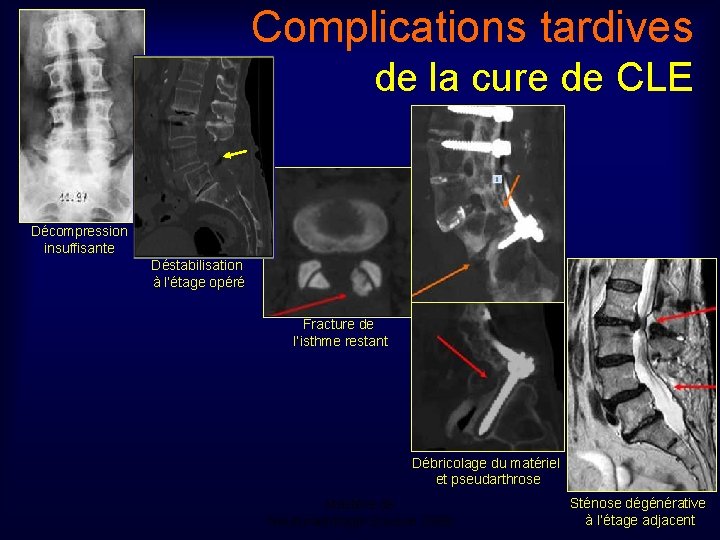 Complications tardives de la cure de CLE Décompression insuffisante Déstabilisation à l’étage opéré Fracture