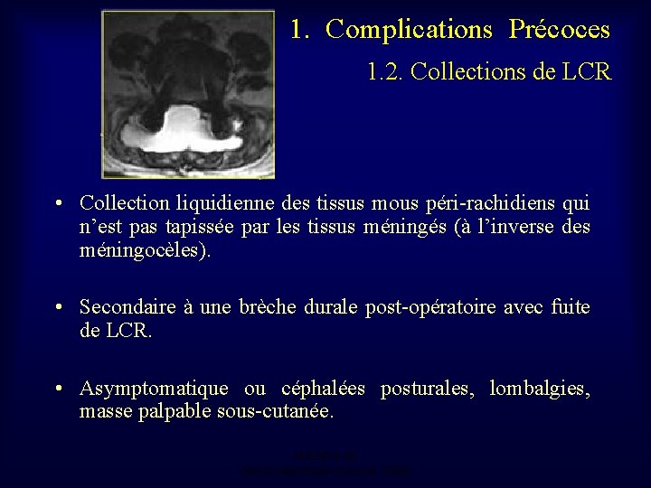 1. Complications Précoces 1. 2. Collections de LCR • Collection liquidienne des tissus mous