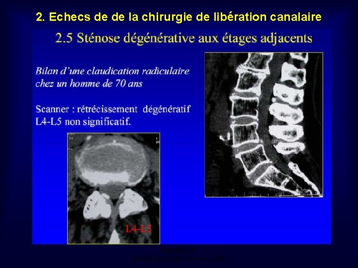 2. Echecs de de la chirurgie de libération canalaire Mastère de Neuroradiologie. Sousse 2008