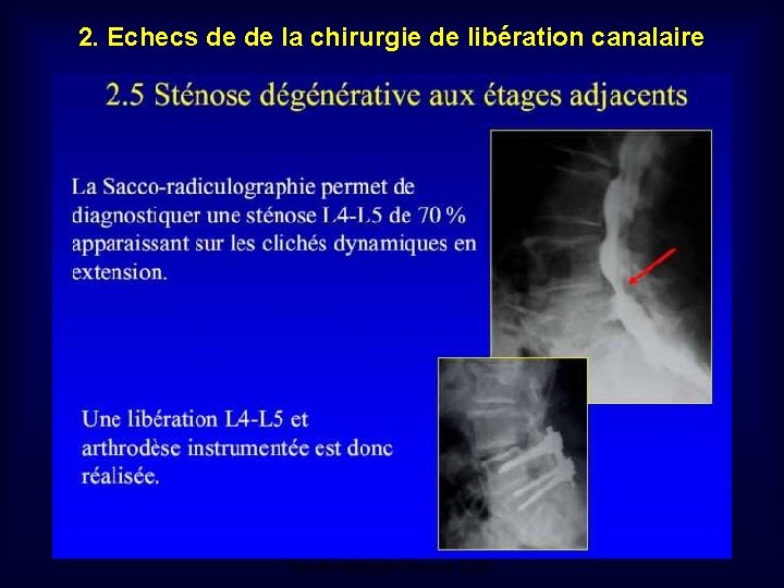 2. Echecs de de la chirurgie de libération canalaire Mastère de Neuroradiologie. Sousse 2008