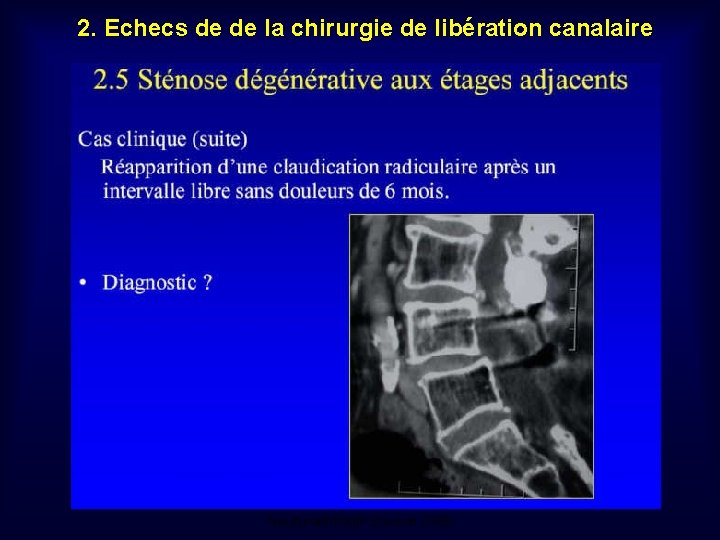 2. Echecs de de la chirurgie de libération canalaire Mastère de Neuroradiologie. Sousse 2008