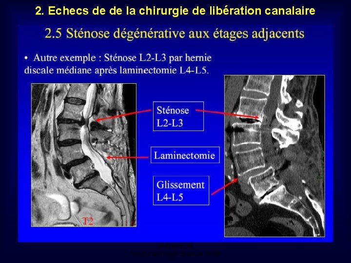 2. Echecs de de la chirurgie de libération canalaire Mastère de Neuroradiologie. Sousse 2008