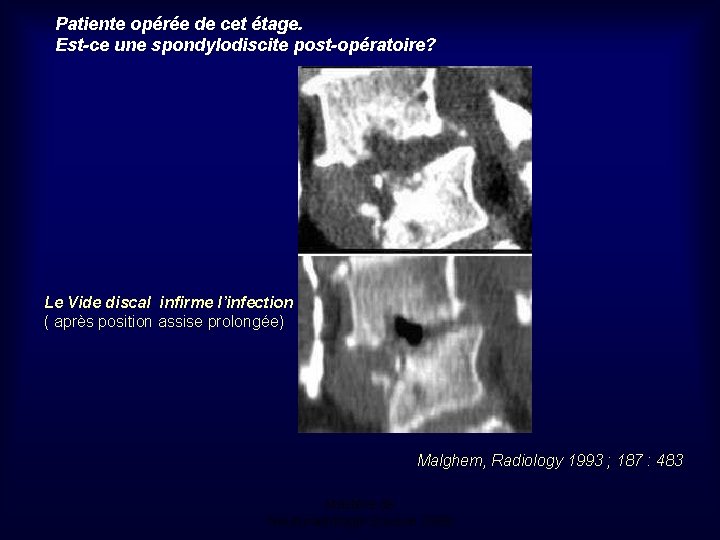 Patiente opérée de cet étage. Est-ce une spondylodiscite post-opératoire? Le Vide discal infirme l’infection