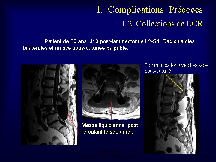 1. Complications Précoces 1. 2. Collections de LCR Patient de 50 ans, J 10