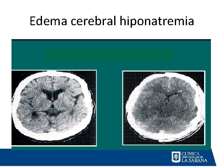 Edema cerebral hiponatremia 