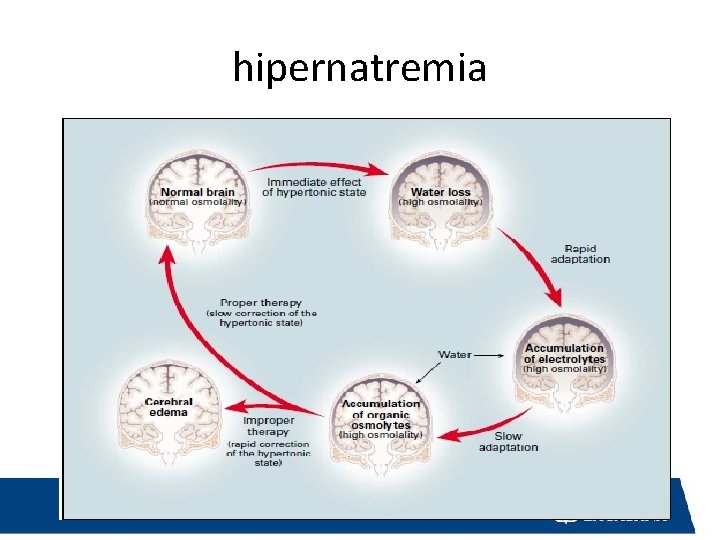 hipernatremia 