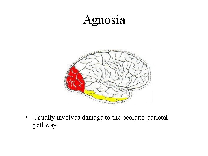 Agnosia • Usually involves damage to the occipito-parietal pathway 