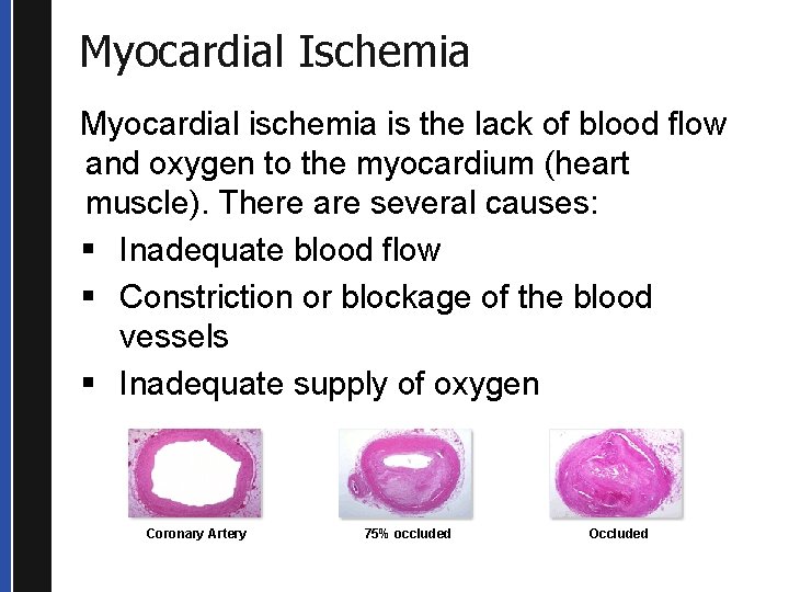 Myocardial Ischemia Myocardial ischemia is the lack of blood flow and oxygen to the