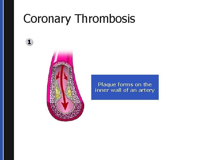 Coronary Thrombosis 1 Plaque forms on the inner wall of an artery 