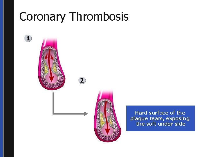 Coronary Thrombosis 1 2 Hard surface of the plaque tears, exposing the soft under