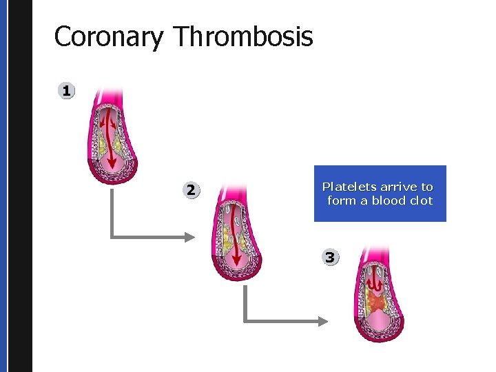 Coronary Thrombosis 1 2 Platelets arrive to form a blood clot 3 