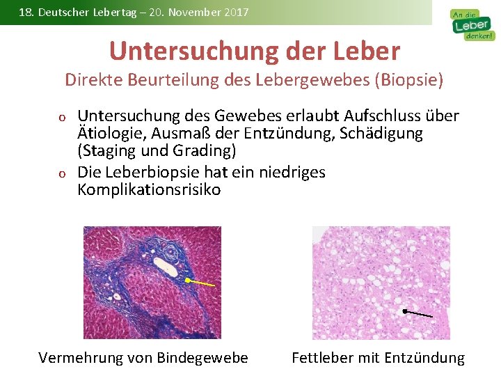 18. Deutscher Lebertag – 20. November 2017 Untersuchung der Leber Direkte Beurteilung des Lebergewebes