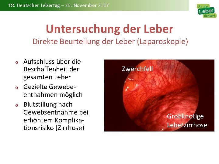 18. Deutscher Lebertag – 20. November 2017 Untersuchung der Leber Direkte Beurteilung der Leber