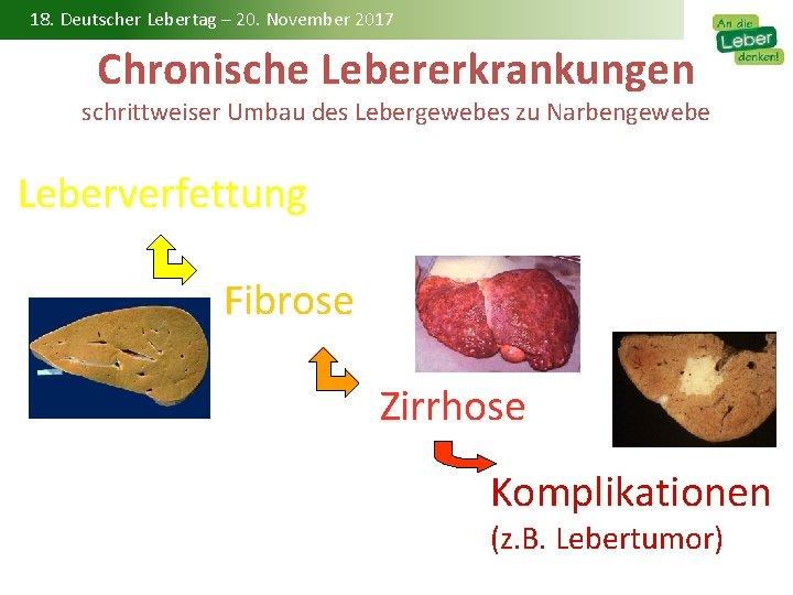 18. Deutscher Lebertag – 20. November 2017 Chronische Lebererkrankungen schrittweiser Umbau des Lebergewebes zu