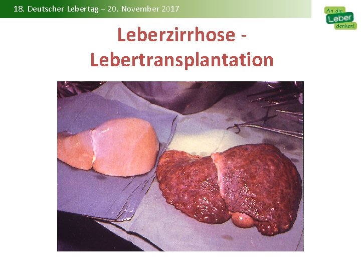 18. Deutscher Lebertag – 20. November 2017 Leberzirrhose - Leberzirrhose Lebertransplantation 