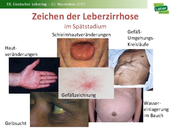 18. Deutscher Lebertag – 20. November 2017 Zeichen der Leberzirrhose im Spätstadium Schleimhautveränderungen Hautveränderungen