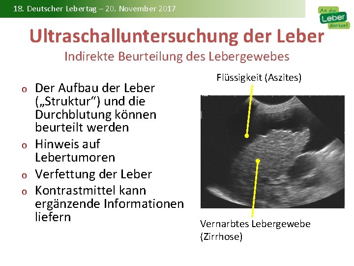 18. Deutscher Lebertag – 20. November 2017 Ultraschalluntersuchung der Leber Indirekte Beurteilung des Lebergewebes