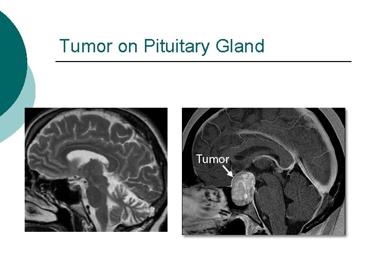 Tumor on Pituitary Gland 