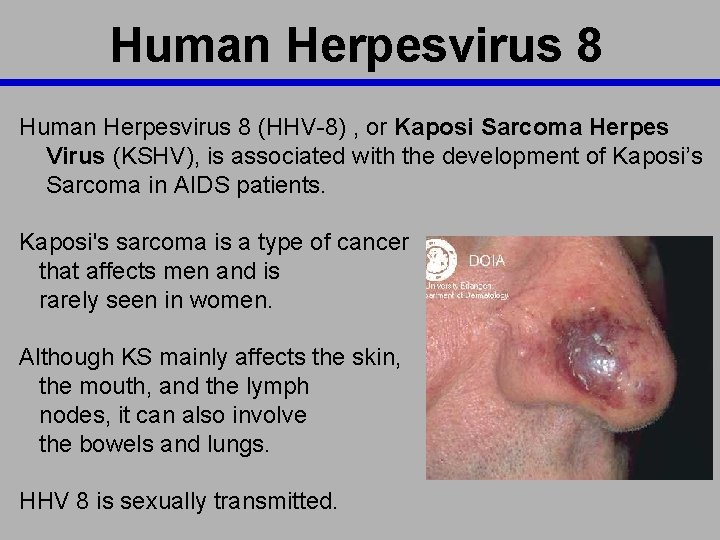 Human Herpesvirus 8 (HHV-8) , or Kaposi Sarcoma Herpes Virus (KSHV), is associated with