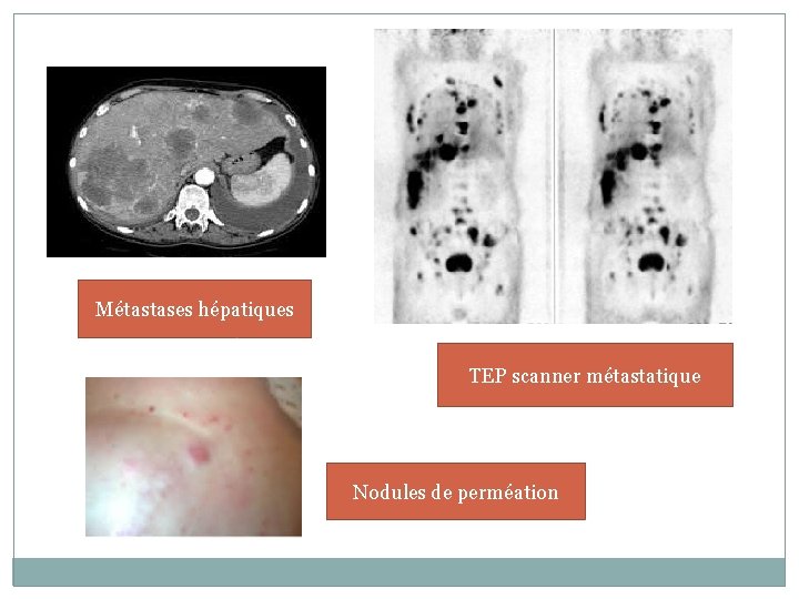 Métastases hépatiques TEP scanner métastatique Nodules de perméation 