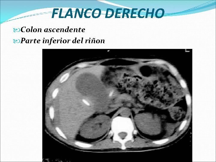 FLANCO DERECHO Colon ascendente Parte inferior del riñon 