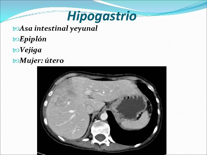 Hipogastrio Asa intestinal yeyunal Epiplón Vejiga Mujer: útero 