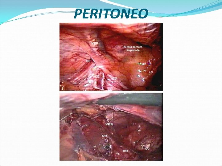 PERITONEO 