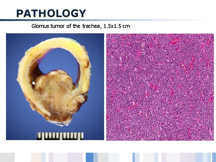 PATHOLOGY Glomus tumor of the trachea, 1. 5 x 1. 5 cm 