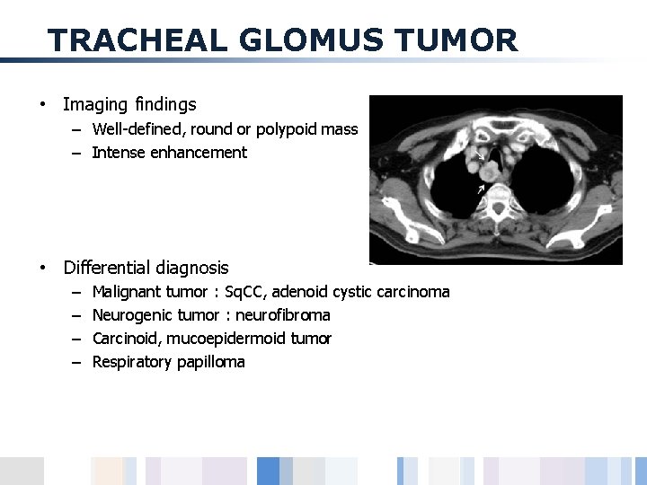 TRACHEAL GLOMUS TUMOR • Imaging findings – Well-defined, round or polypoid mass – Intense