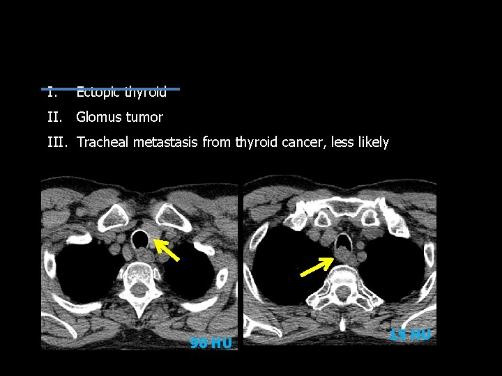 I. Ectopic thyroid II. Glomus tumor III. Tracheal metastasis from thyroid cancer, less likely