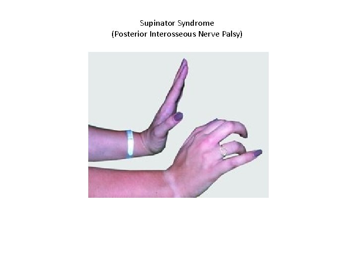 Supinator Syndrome (Posterior Interosseous Nerve Palsy) 