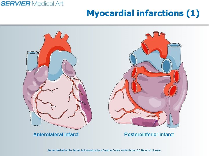 Myocardial infarctions (1) Anterolateral infarct Posteroinferior infarct Servier Medical Art by Servier is licensed Myocardial infarctions (1) Anterolateral infarct Posteroinferior infarct Servier Medical Art by Servier is licensed