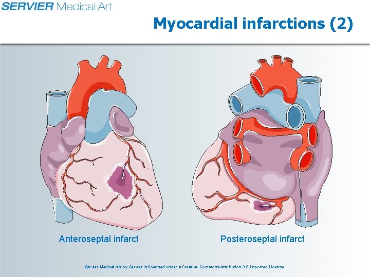 Myocardial infarctions (2) Anteroseptal infarct Posteroseptal infarct Servier Medical Art by Servier is licensed Myocardial infarctions (2) Anteroseptal infarct Posteroseptal infarct Servier Medical Art by Servier is licensed