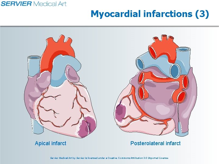 Myocardial infarctions (3) Apical infarct Posterolateral infarct Servier Medical Art by Servier is licensed Myocardial infarctions (3) Apical infarct Posterolateral infarct Servier Medical Art by Servier is licensed