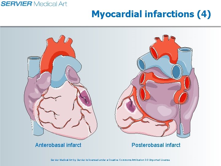 Myocardial infarctions (4) Anterobasal infarct Posterobasal infarct Servier Medical Art by Servier is licensed Myocardial infarctions (4) Anterobasal infarct Posterobasal infarct Servier Medical Art by Servier is licensed