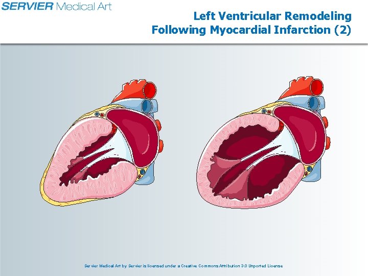 Left Ventricular Remodeling Following Myocardial Infarction (2) Servier Medical Art by Servier is licensed Left Ventricular Remodeling Following Myocardial Infarction (2) Servier Medical Art by Servier is licensed