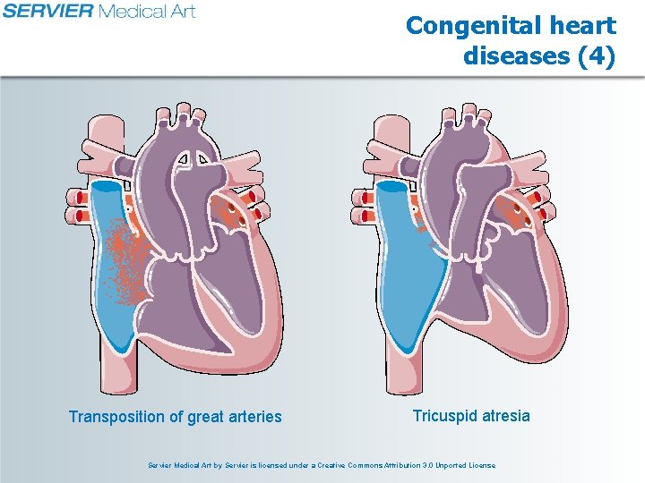 Congenital heart diseases (4) Transposition of great arteries Tricuspid atresia Servier Medical Art by Congenital heart diseases (4) Transposition of great arteries Tricuspid atresia Servier Medical Art by