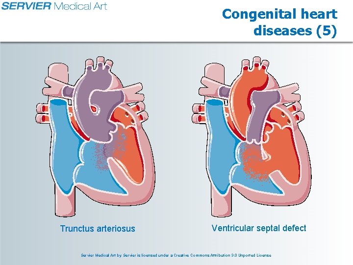 Congenital heart diseases (5) Trunctus arteriosus Ventricular septal defect Servier Medical Art by Servier Congenital heart diseases (5) Trunctus arteriosus Ventricular septal defect Servier Medical Art by Servier