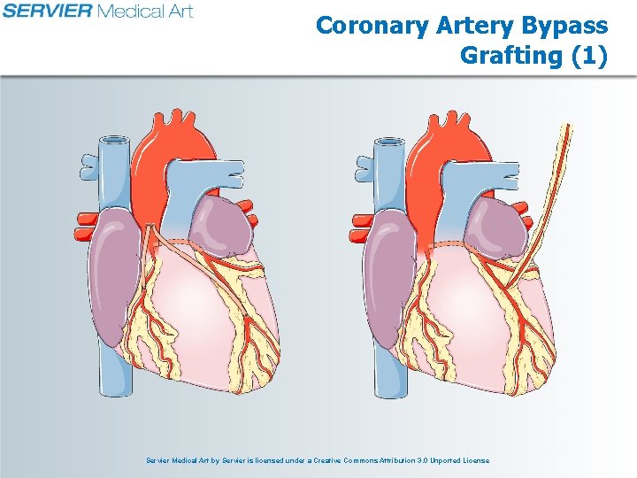 Coronary Artery Bypass Grafting (1) Servier Medical Art by Servier is licensed under a Coronary Artery Bypass Grafting (1) Servier Medical Art by Servier is licensed under a