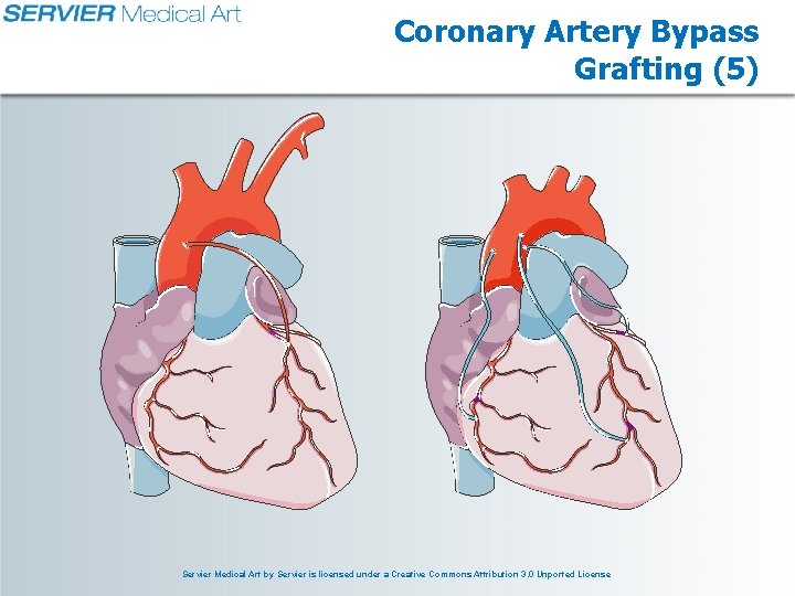 Coronary Artery Bypass Grafting (5) Servier Medical Art by Servier is licensed under a Coronary Artery Bypass Grafting (5) Servier Medical Art by Servier is licensed under a