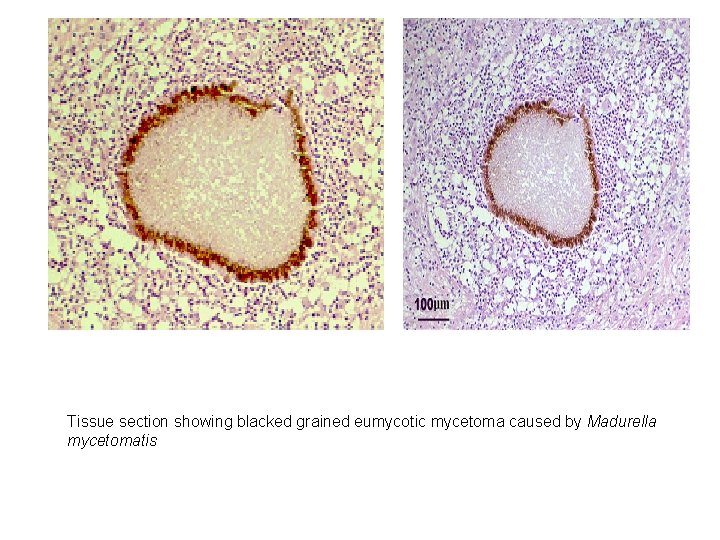 Tissue section showing blacked grained eumycotic mycetoma caused by Madurella mycetomatis 