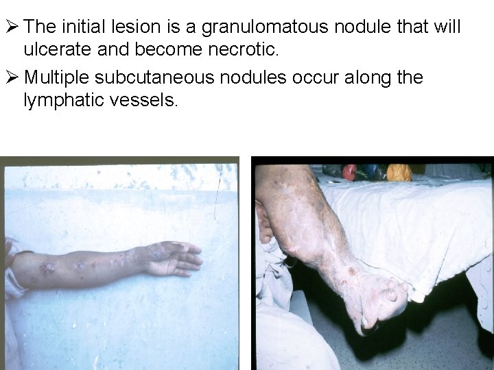 Ø The initial lesion is a granulomatous nodule that will ulcerate and become necrotic.