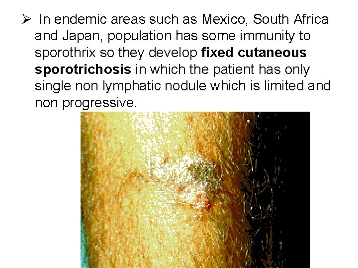 Ø In endemic areas such as Mexico, South Africa and Japan, population has some