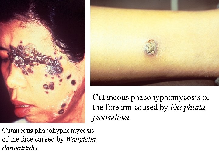 Cutaneous phaeohyphomycosis of the forearm caused by Exophiala jeanselmei. Cutaneous phaeohyphomycosis of the face