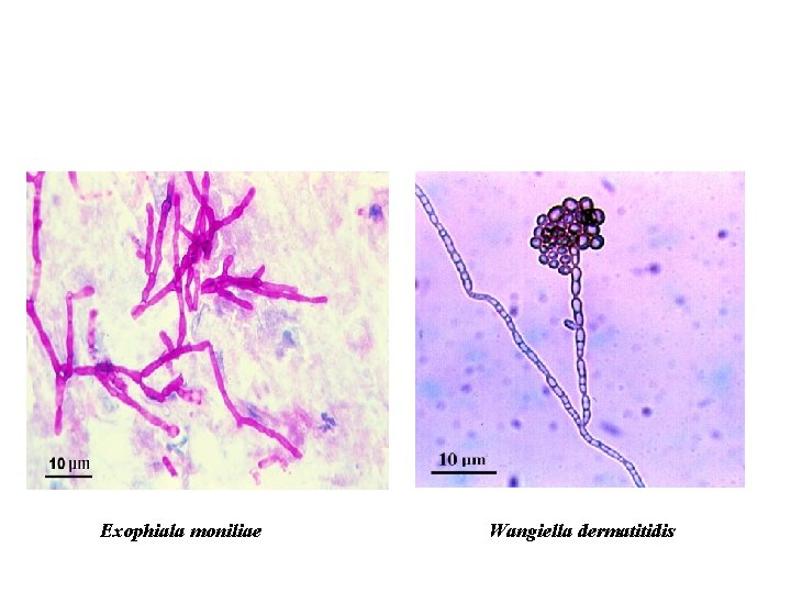 Exophiala moniliae Wangiella dermatitidis 