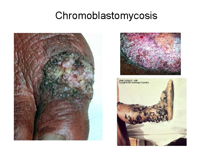 Chromoblastomycosis 