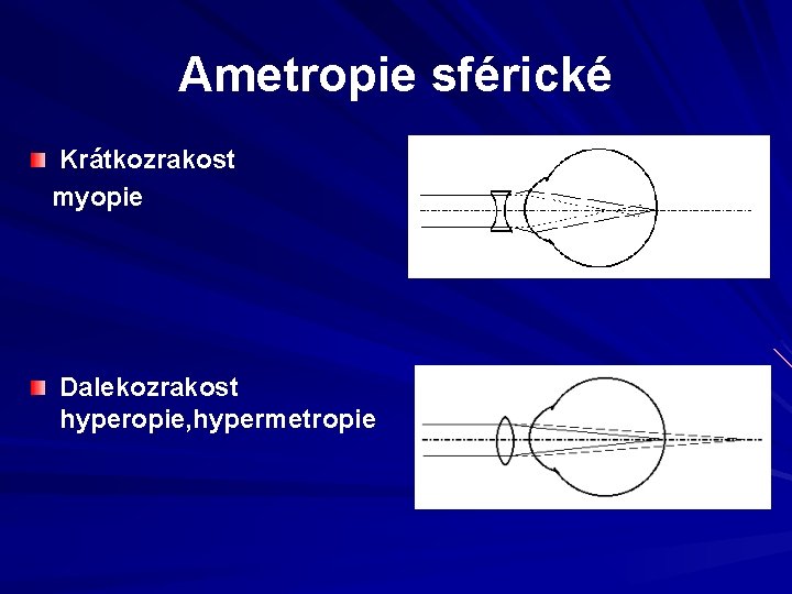 Ametropie sférické Krátkozrakost myopie Dalekozrakost hyperopie, hypermetropie Ametropie sférické Krátkozrakost myopie Dalekozrakost hyperopie, hypermetropie