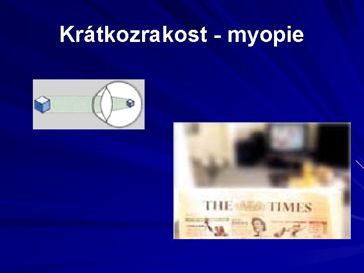 Krátkozrakost - myopie Krátkozrakost - myopie