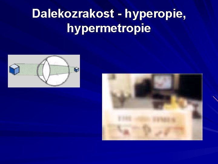 Dalekozrakost - hyperopie, hypermetropie Dalekozrakost - hyperopie, hypermetropie